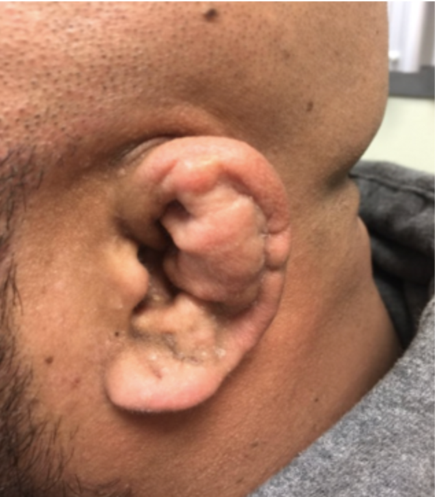 Untreated auricular hematoma, known as cauliflower ear