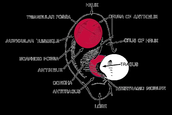 Ear anatomy diagram highlighting the triangular fossa and the conchal bowl