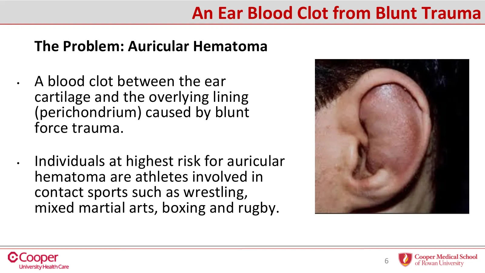 Slide 6 of 32: An ear blood clot from blunt trauma