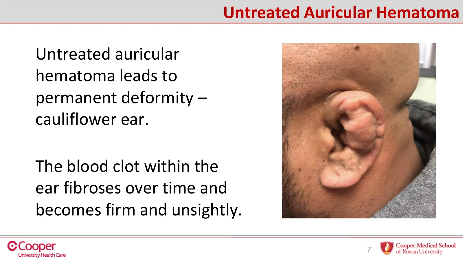 Slide 7 of 32: Untreated auricular hematoma